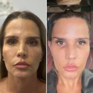 Dj Taty Zatto faz procedimento para amenizar olheiras