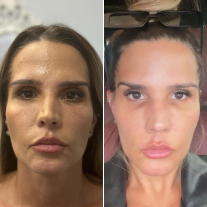 Dj Taty Zatto faz procedimento para amenizar olheiras