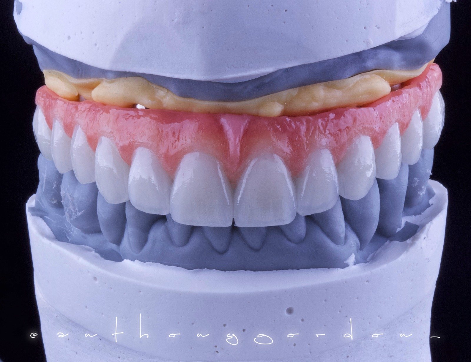 Dr. Anthony Gordon desvenda o poder dos implantes dentários tipo protocolo 18 implantes dentários tipo protocolo