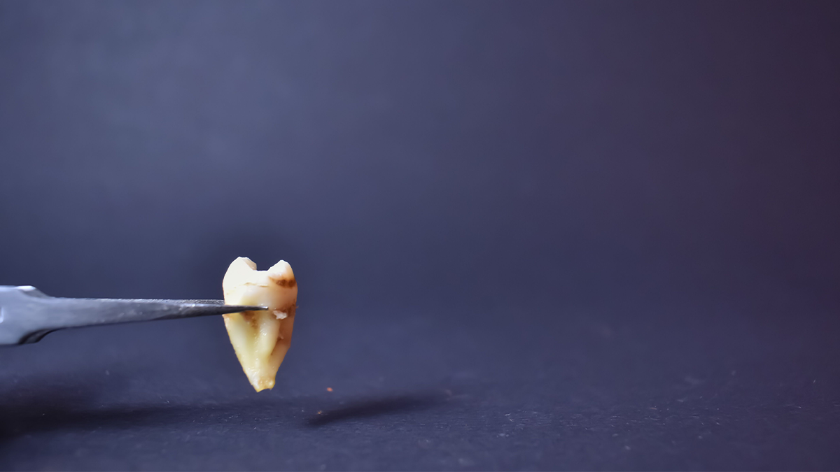 Como é feita a Cirurgia do Siso? 18 Como é feita a cirurgia do siso 2_