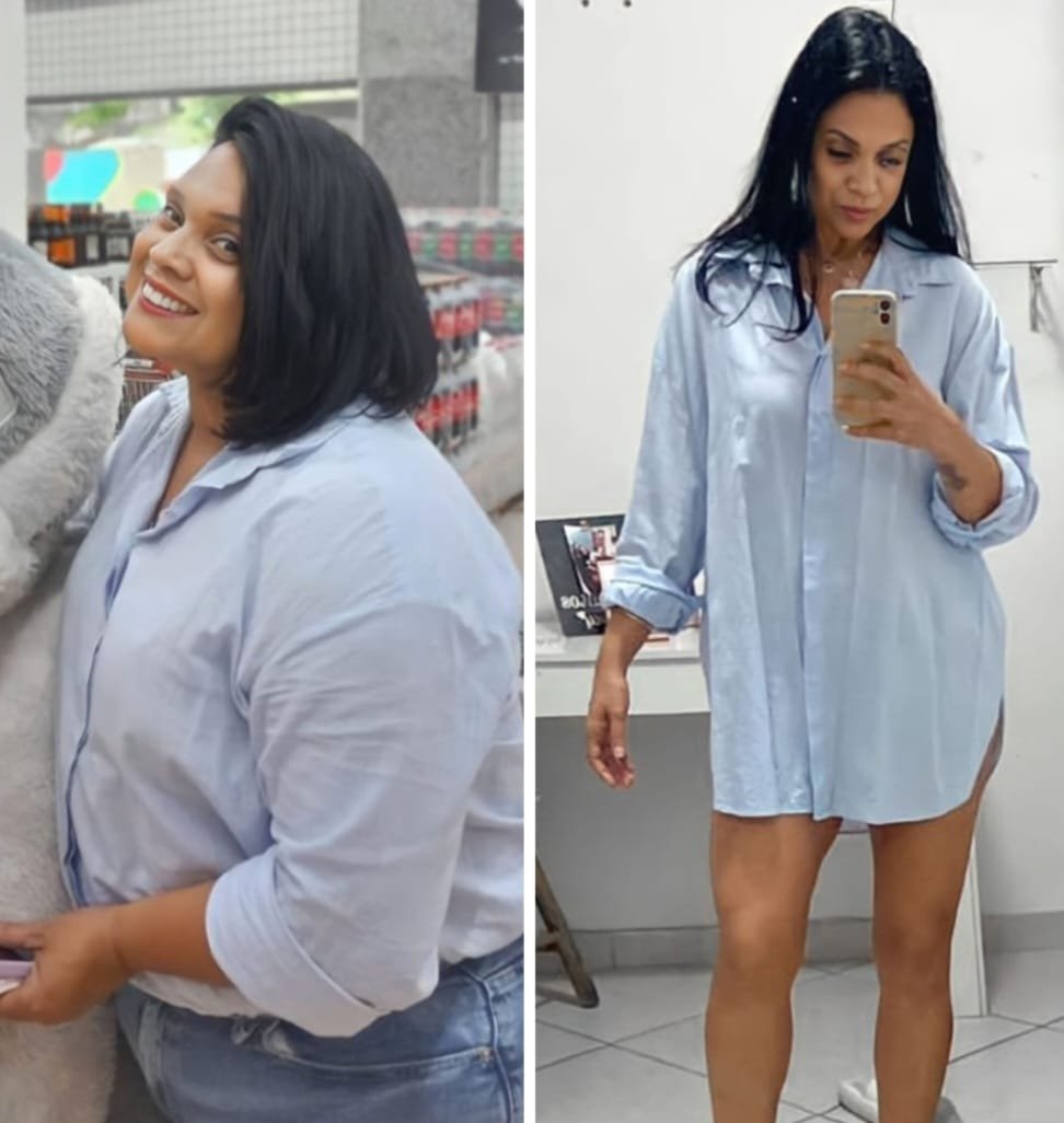 Cirurgias Plásticas combinadas é seguro? Dr. Sérgio Cruz revela receio dos pacientes 19 IMG 20231118 WA00831