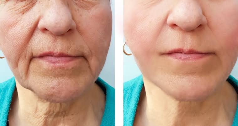 Aumento na procura de cirurgias plásticas em idosos reflete busca por rejuvenescimento 18 IMG 20240620 WA0017