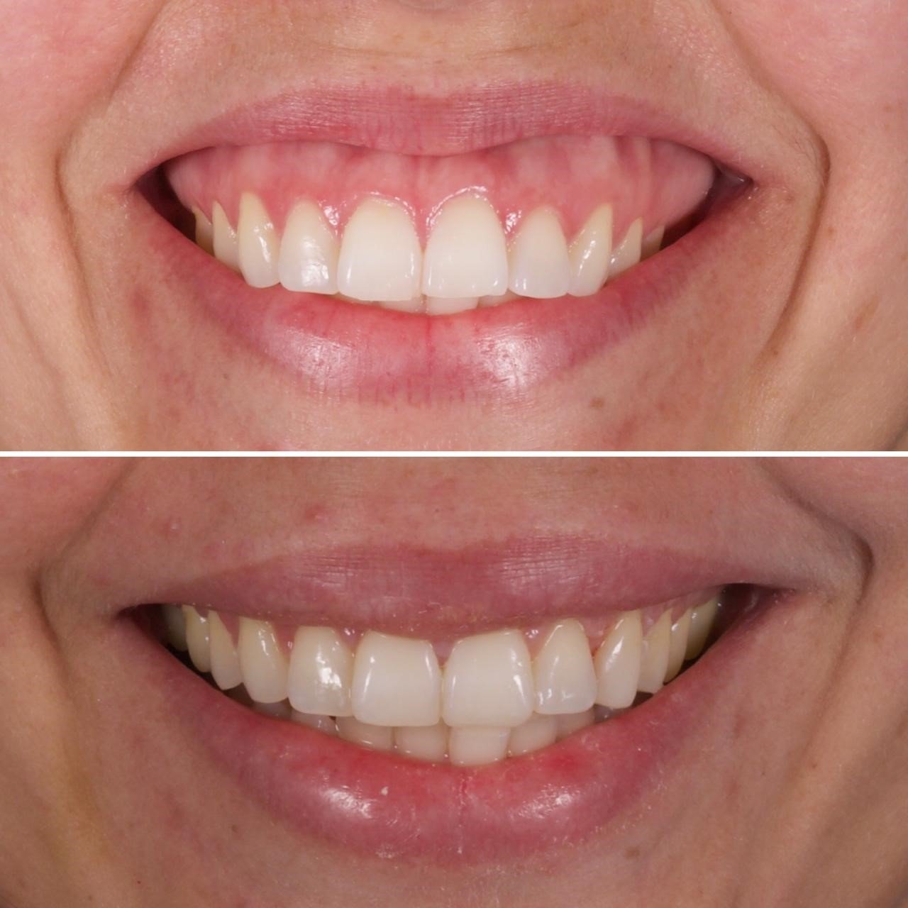 Famosos Buscam Tratamento de Reposicionamento Labial da Dra. Renata Horn para Corrigir Sorriso 17 111