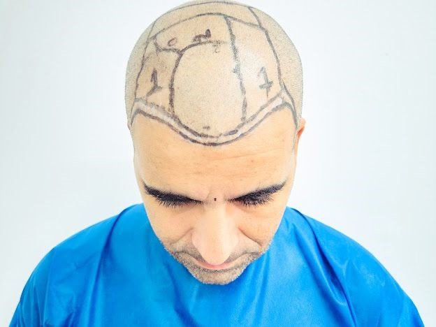 A Excelência em Transplante Capilar: Dr. Miguel Matteo Revoluciona a Estética Capilar 18 2 16
