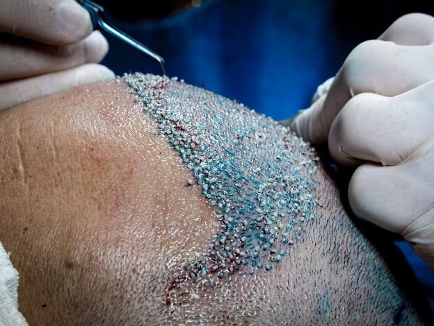 A Excelência em Transplante Capilar: Dr. Miguel Matteo Revoluciona a Estética Capilar 19 3 4
