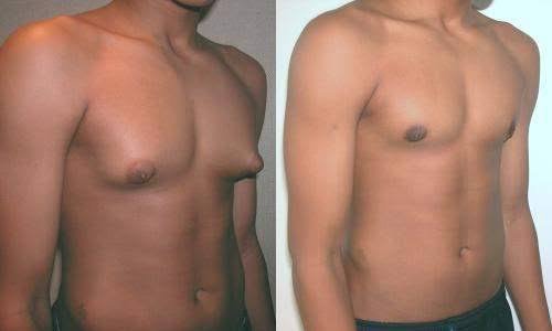 Ginecomastia na adolescência: O papel dos pais no apoio e superação dos jovens