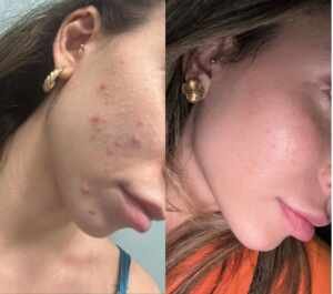 Dra. Dayoha Apresenta o Fotona Booster: Tecnologia e Eficácia no Rejuvenescimento Facial