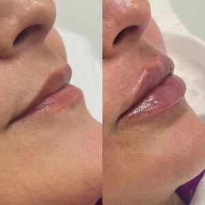 Benefícios do Preenchimento Labial na Goioerê Clínica e Harmonização facial com Dra. Daniella Oliveira