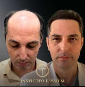 Transplante Capilar de Alta Densidade:A Revolução da Técnica PHT no Instituto Elysium.