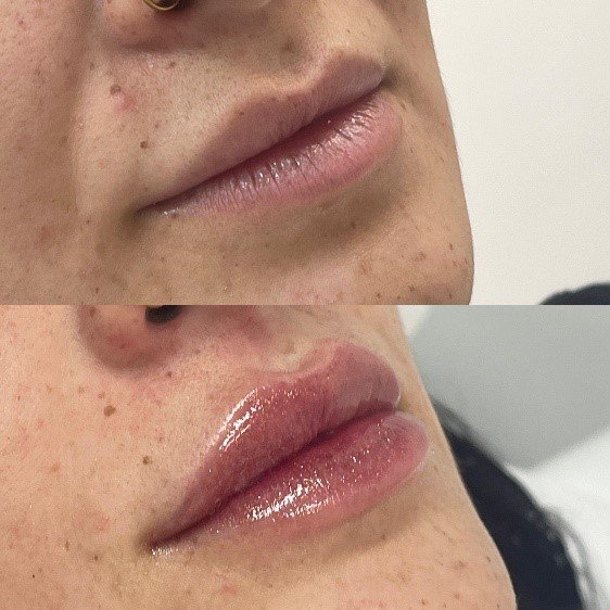 Benefícios do Preenchimento Labial na Goioerê Clínica e Harmonização facial com Dra. Daniella Oliveira 19 Imagem9 1