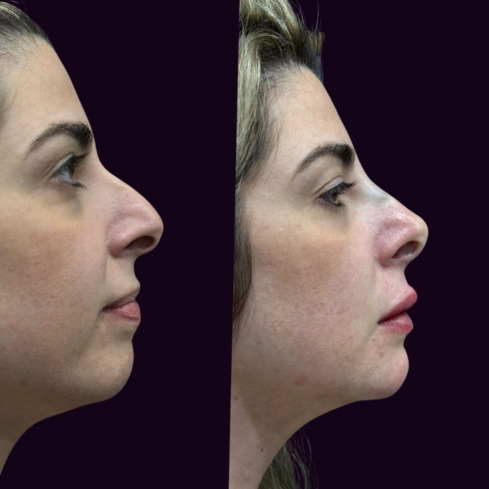 Perfiloplastia Não Cirúrgica: A Revolução Estética na Harmonização Facial 21 4715080a b09d 4241 ab1c 27857be8950f 1