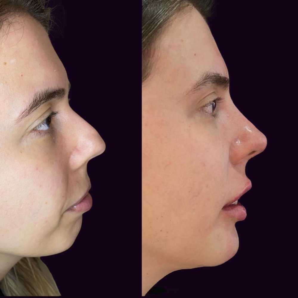 Perfiloplastia Não Cirúrgica: A Revolução Estética na Harmonização Facial 22 56dcbb47 a079 467d 80b7 04d569c06c85 1