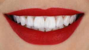 As lentes de contato dental podem corrigir qualquer problema estético?