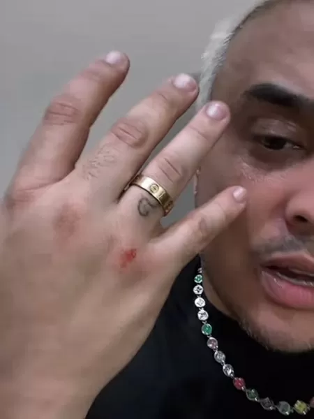 Kauan, dupla de Matheus, leva tombo em show no São João de Caruaru 17 kauan machuca a mao apos queda em show no sao joao de caruaru