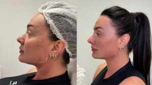 Juju Salimeni impressiona com antes e depois de procedimentos feitos pela Dra. Karlla Salles