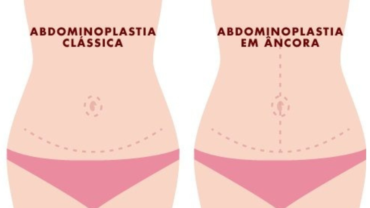 Abdominoplastia pós-bariátrica: especialista detalha como cirurgia moderna reconstrói contorno abdominal 18 unnamed 2025 11 19T140216.773