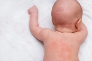 Introdução alimentar exige atenção a sinais de alergia em bebês, alerta especialista