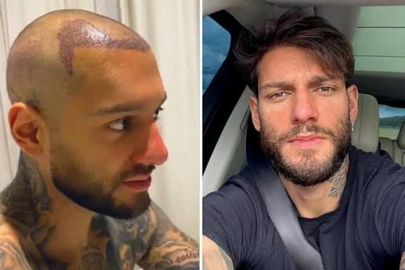 Existe idade certa para transplante capilar? Veja os famosos que fizeram ainda jovens