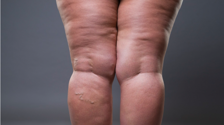 Lipedema deixa de ser invisível e ganha critérios mais claros de diagnóstico