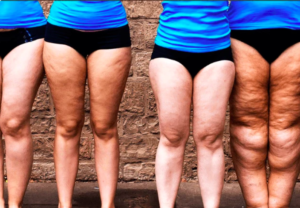 Lipedema: doença ainda pouco conhecida afeta milhões de brasileiras