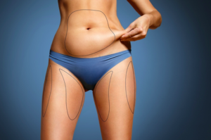 Lipoaspiração localizada se destaca pela rapidez, praticidade e bons resultados
