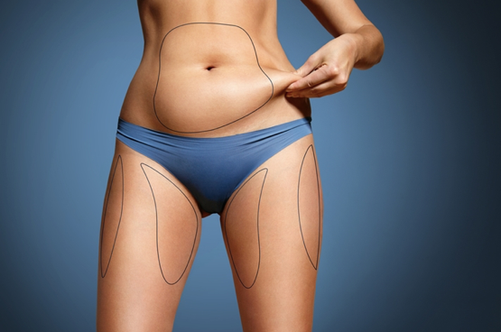 Lipoaspiração localizada se destaca pela rapidez, praticidade e bons resultados Lipoaspiração localizada se destaca pela rapidez, praticidade e bons resultados