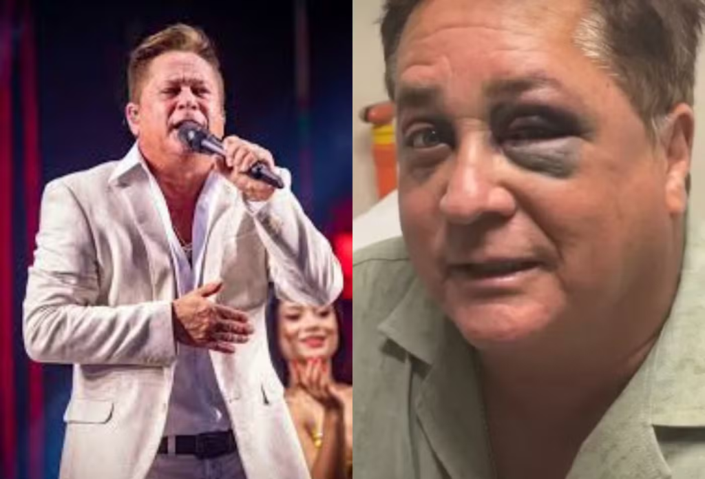 Leonardo detalha acidente que causou fratura no rosto e brinca sobre estar alcoolizado no momento