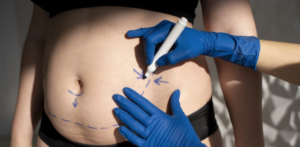 Cirurgias pós-gestação crescem no Brasil e Mommy Makeover vira tendência entre mães