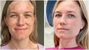 Atriz e empresária Maqueli Gewehr mostra antes e depois de tratamento contra melasma
